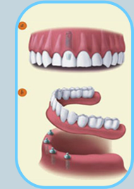 all on 4 dental implants