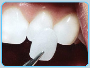 veneers at Torgersen Dental